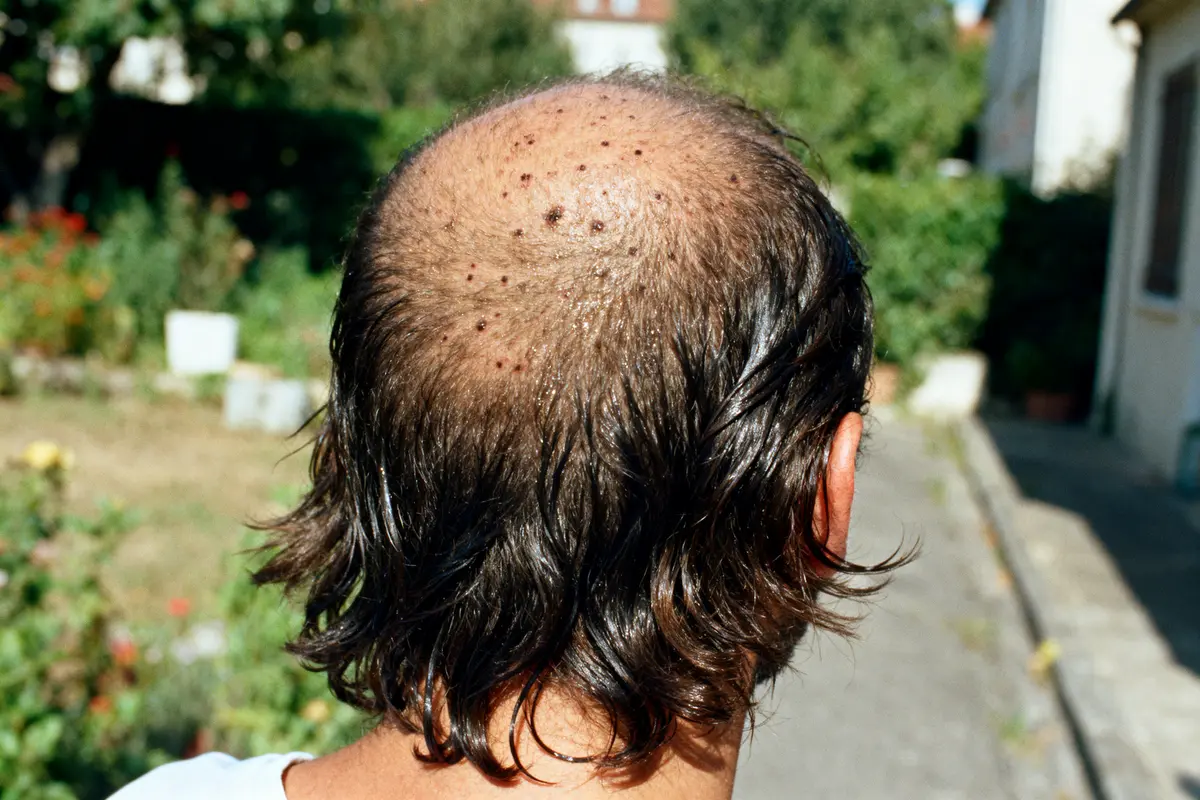 Cheveux qui graissent vite : Comment trouver des solutions ?