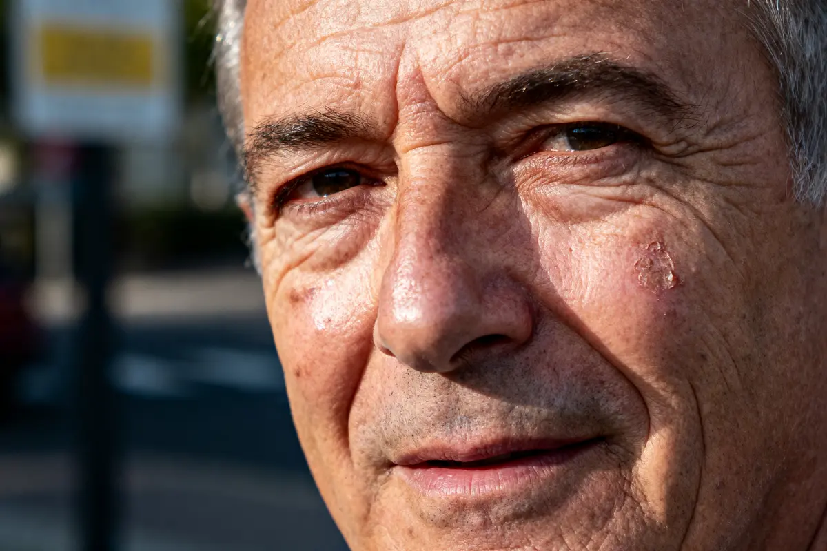 Visage d'un homme âgé avec des rides et une lésion cutanée, en extérieur par temps ensoleillé.