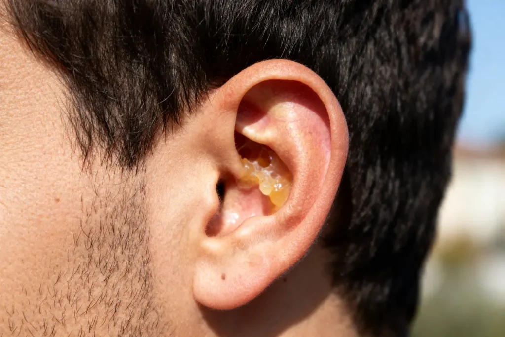 Oreille humaine avec cérumen visible causant un intérieur de l'oreille qui gratte